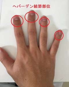 手の指の変形 へバーデン結節とは 津市おざき鍼灸接骨院