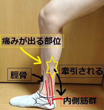 走るスポーツに多いすねの痛み シンスプリント 脛骨過労性骨膜炎 とは 津市おざき鍼灸接骨院